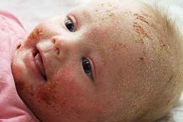 Eczema Baby