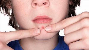 how to heal teen acne